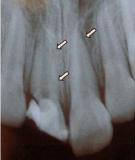 Conservative and Aesthetic Emergency Management in Adolescent with Complex Crown-Root Fracture and Simultaneous Oblique Root Fracture in Upper Maxillary Central Incisor: Clinical Outcome after 18 Months Follow-up Period 