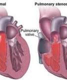 BỆNH LÝ VALVE TIM