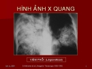 Hình ảnh x quang phế nang