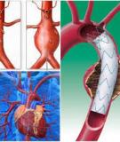 Aneurysm - Động Mạch Nổi Phình.