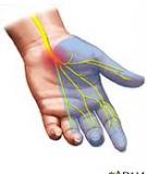 Hội Chứng Nghẽn Rãnh Cổ Tay Carpal Tunnel Syndrome