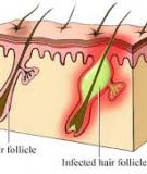 Viêm Chân Lông (Foliculitis)