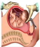 Những trường hợp nào cần phải mổ đẻ 