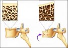 Nguyên nhân và cách phòng ngừa loãng xương