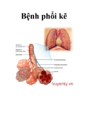 Bệnh phổi kẽ 