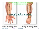 Bài giảng Sơ cứu gãy xương - GV. Vũ Văn Tiến