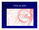 Bài giảng Viêm tai giữa