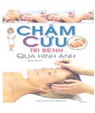 Hướng dẫn Châm cứu trị bệnh qua hình ảnh: Phần 1