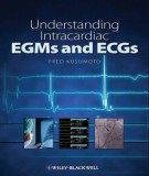 Understanding intracardiac EGMs and ECGs: Part 2