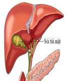 Các phương pháp phẫu thuật trong điều trị sỏi trong gan