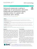 Aortocaval compression resulting in sudden loss of consciousness and severe bradycardia and hypotension during cesarean section in a patient with subvalvular aortic stenosis