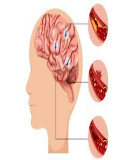 Đột quỵ não (Bệnh học cơ sở)